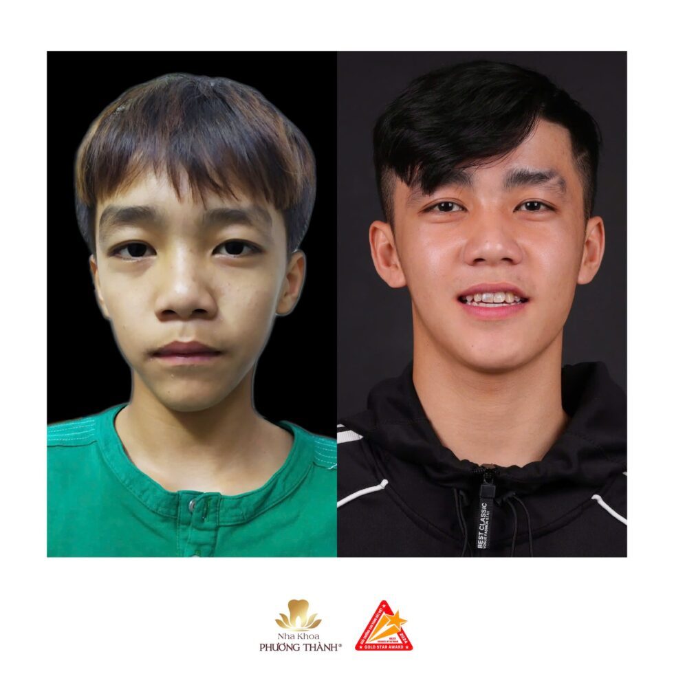 Hình ảnh trước sau niềng răng, cải thiện thẩm mỹ khuôn mặt tại Phương Thành