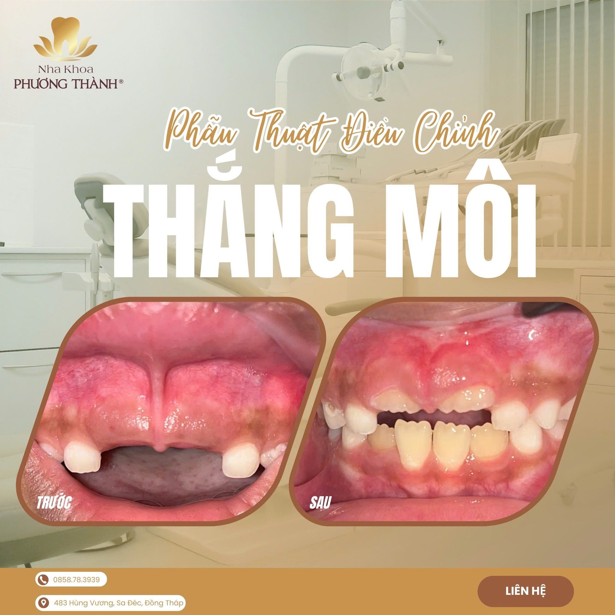 Hình ảnh trước sau phẫu thuật thắng môi tại Nha Khoa Phương Thành