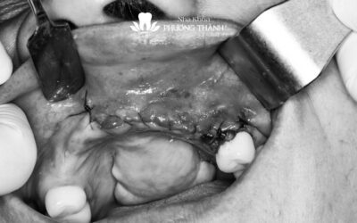 Phẫu thuật nang xương hàm