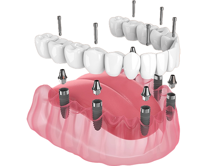 Mô phỏng phục hình toàn hàm dưới bằng implant – giải pháp phục hồi răng mất hiệu quả tại Nha Khoa Phương Thành