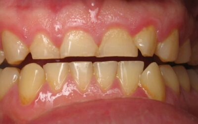 Nghiến răng có thể gây tổn thương tủy răng