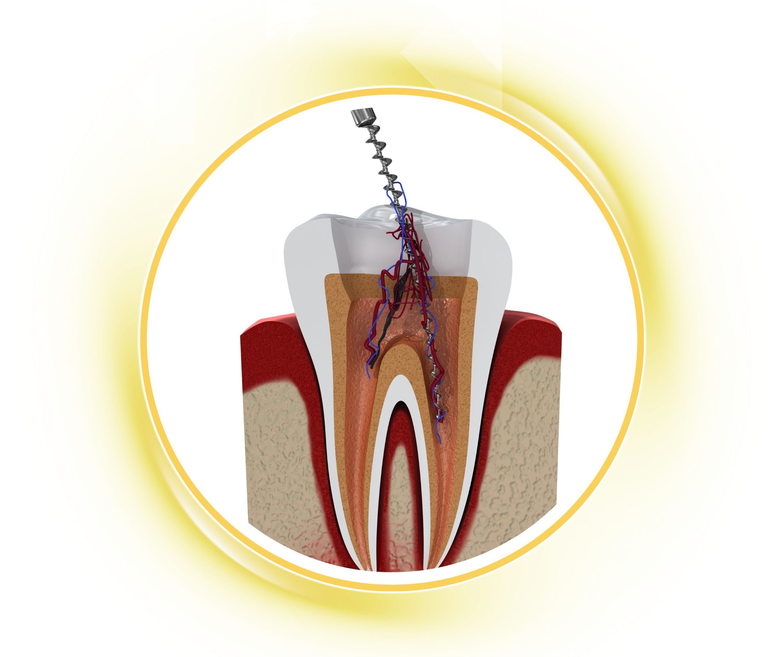 Minh họa quy trình điều trị tủy răng (nội nha), làm sạch và tạo hình ống tủy tại Nha khoa Phương Thành