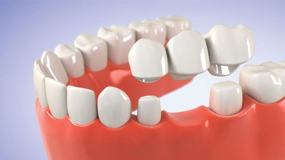 Dental bridge illustration for restoring missing teeth in dentistry