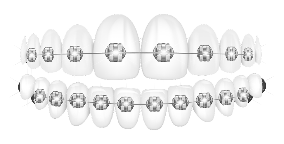Mô phỏng niềng răng mắc cài kim loại trên răng hàm trên và dưới – phương pháp chỉnh nha truyền thống tại Nha Khoa Phương Thành