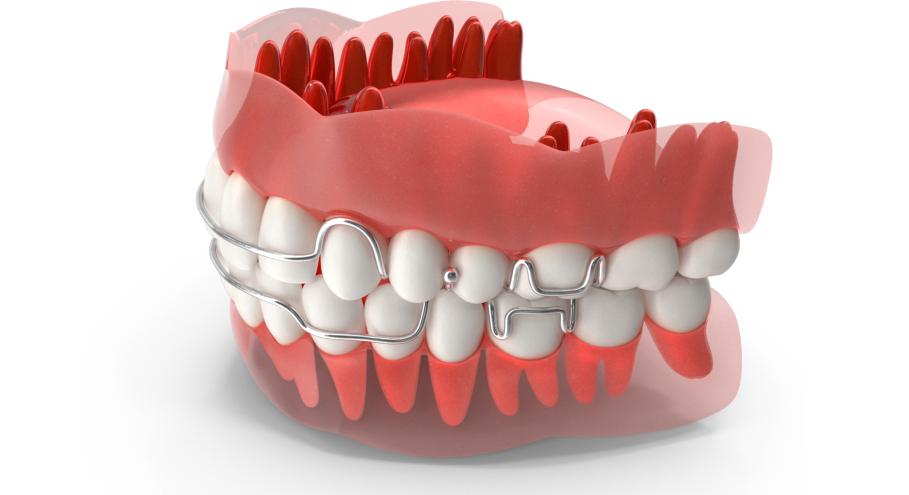 Mô phỏng niềng răng mắc cài kim loại với cấu trúc nướu bán trong suốt – minh họa kỹ thuật chỉnh nha tại Nha Khoa Phương Thành