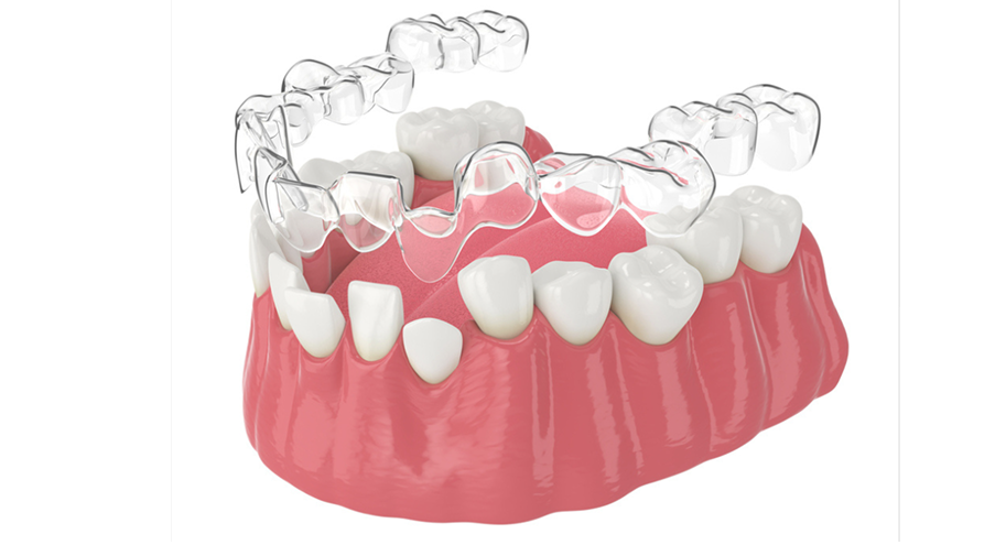 Mô phỏng khay niềng trong suốt ôm sát răng – giải pháp chỉnh nha thẩm mỹ không mắc cài tại Nha Khoa Phương Thành