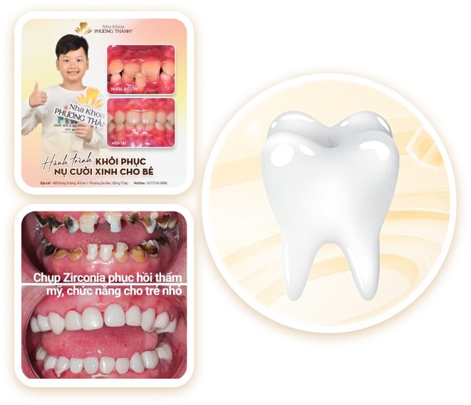 Phục hồi nụ cười cho trẻ bằng mão Zirconia – cải thiện thẩm mỹ và chức năng ăn nhai tại Nha Khoa Phương Thành