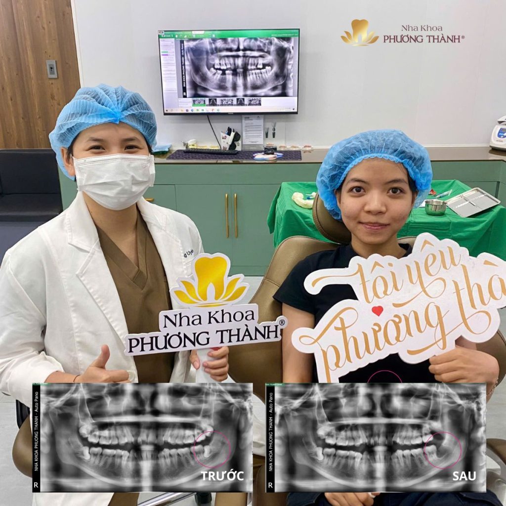 Tạm biệt nổi ám ảnh răng khôn