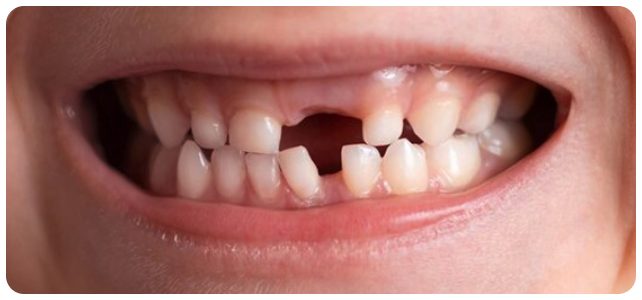 Răng sữa bị mất ở trẻ em – giai đoạn thay răng tự nhiên cần theo dõi và chăm sóc tại Nha Khoa Phương Thành