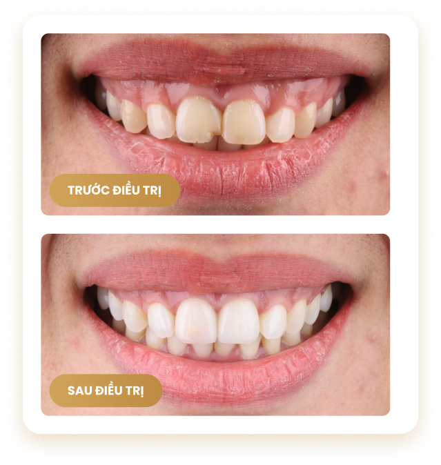 Nụ cười trước và sau điều trị – cải thiện màu sắc, đường viền nướu và thẩm mỹ tại Nha Khoa Phương Thành