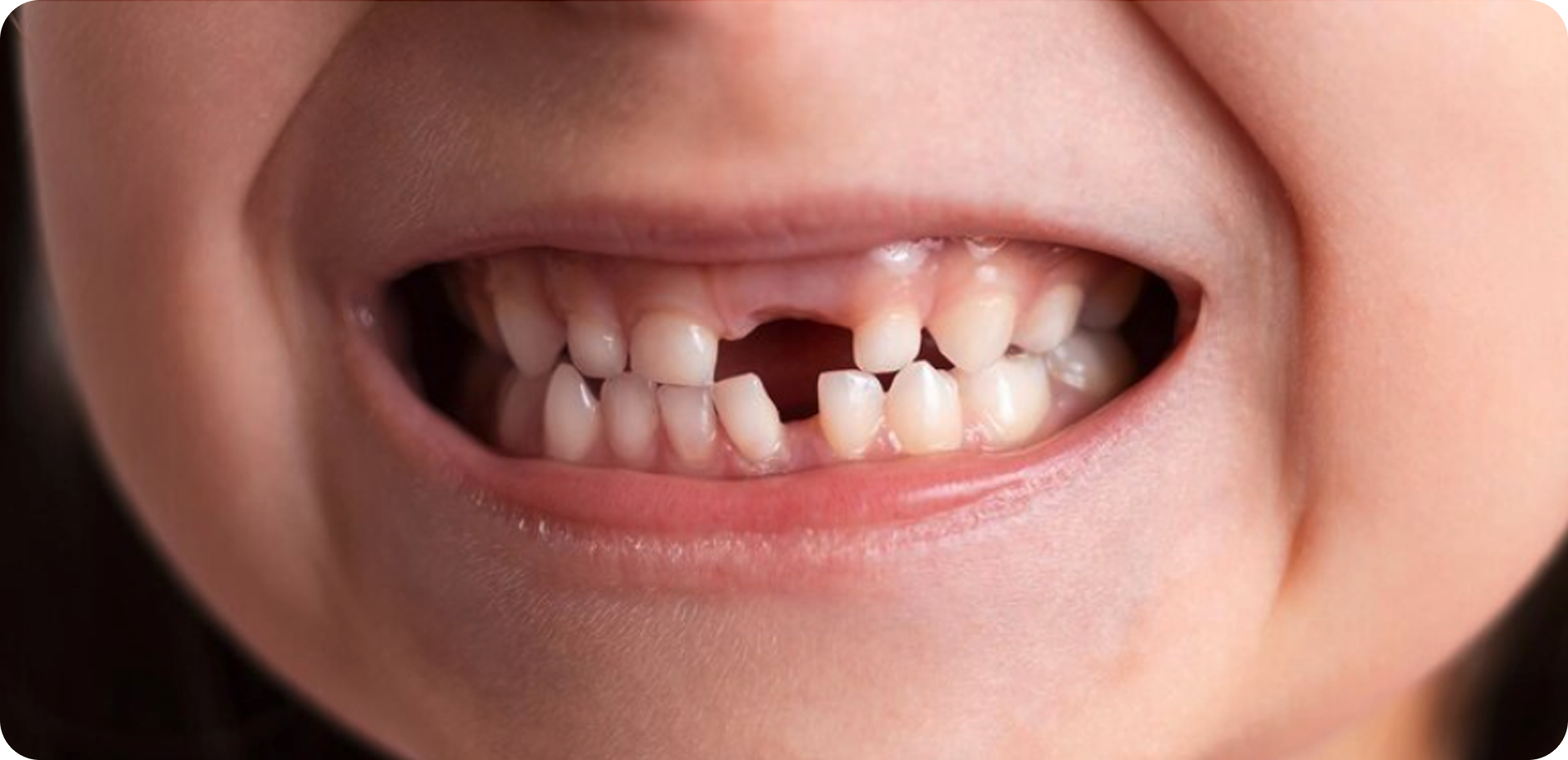 Răng sữa bị mất ở trẻ em – giai đoạn thay răng tự nhiên cần theo dõi và chăm sóc tại Nha Khoa Phương Thành