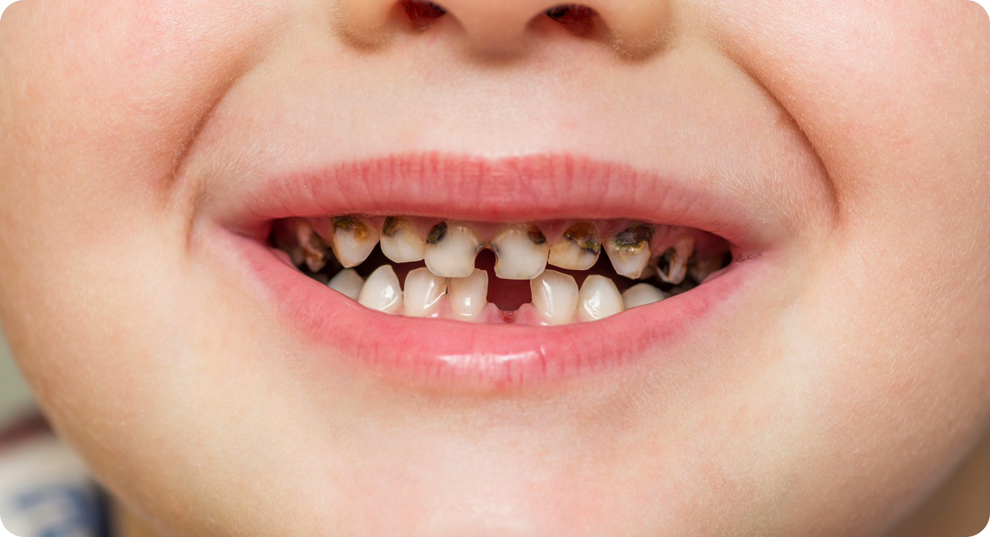 Răng sâu nặng và hư tổn nghiêm trọng – cảnh báo hậu quả khi không chăm sóc răng miệng đúng cách