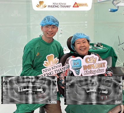 Cấy ghép Implant không đau tại nha khoa Phương Thành