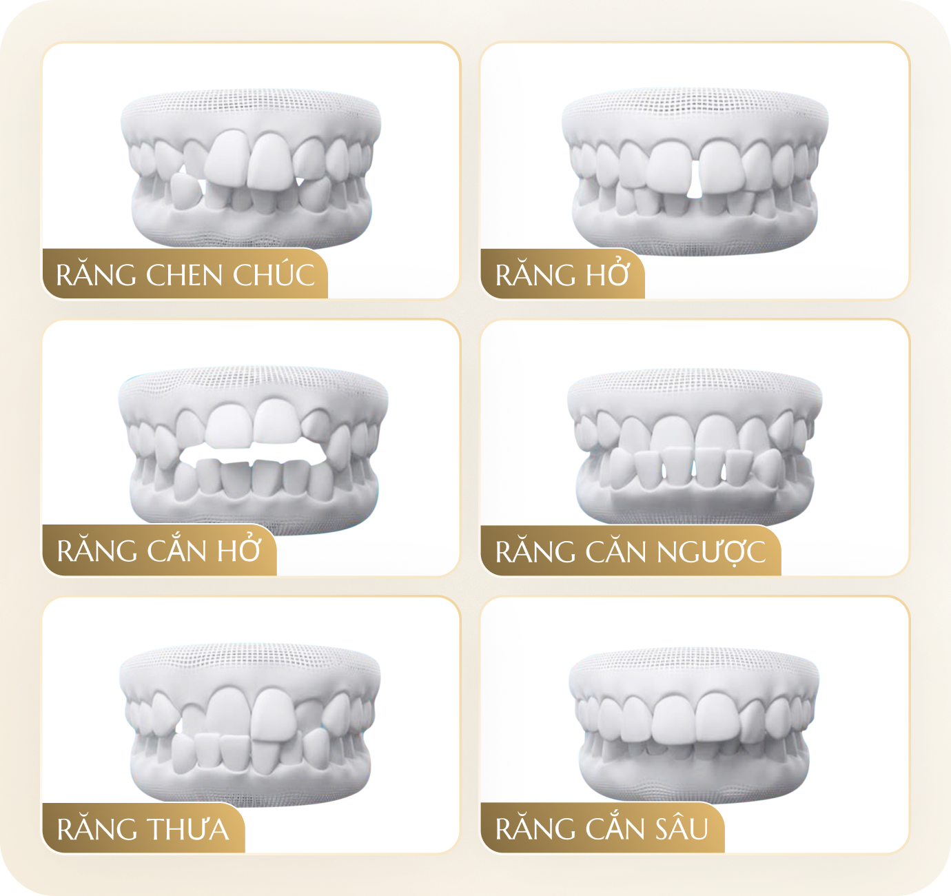 Mô phỏng các dạng sai lệch khớp cắn: chen chúc, hở, cắn hở, cắn ngược, thưa, cắn sâu – tư vấn chỉnh nha tại Nha Khoa Phương Thành