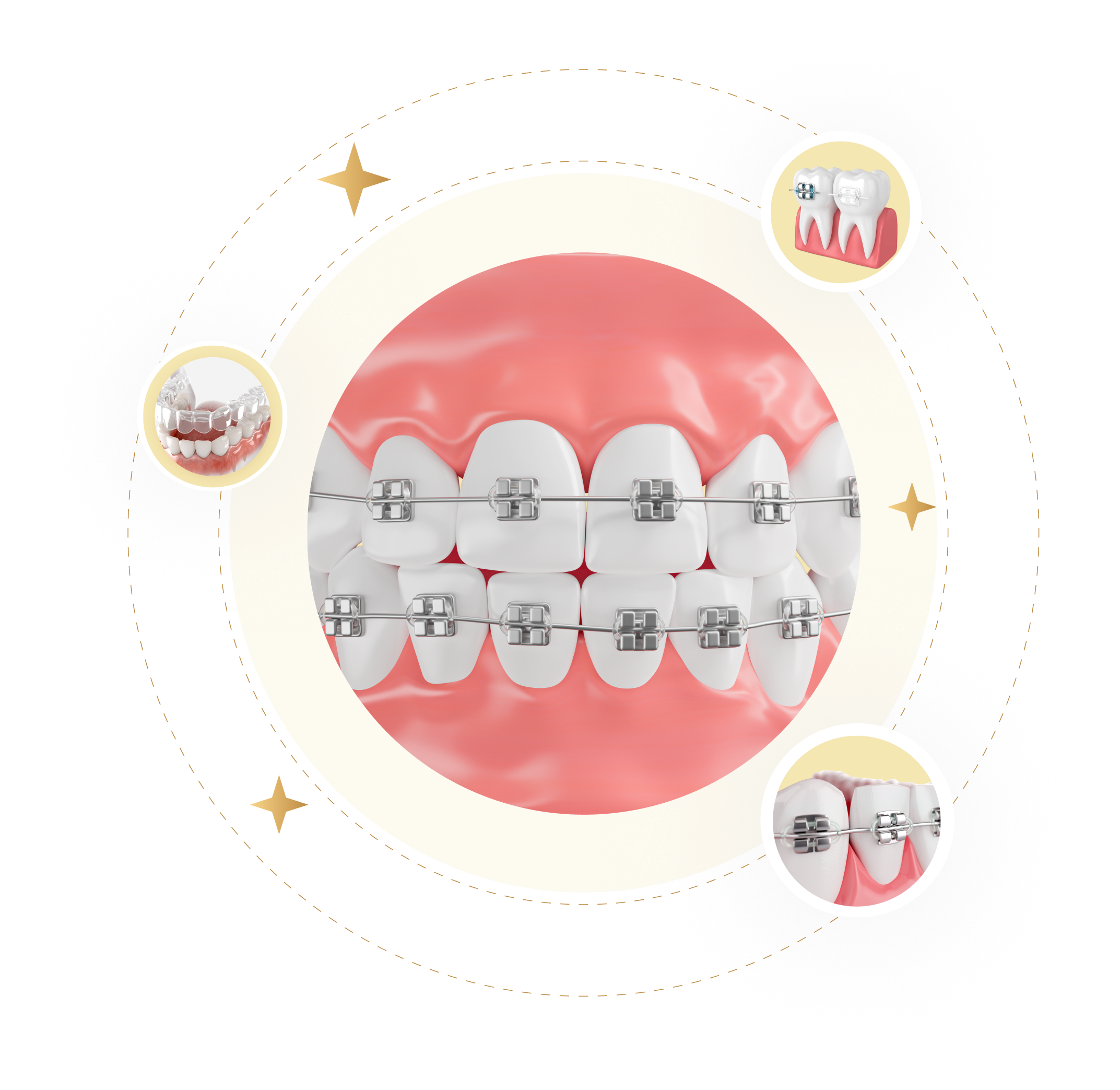 Mô phỏng niềng răng mắc cài kim loại – giải pháp chỉnh nha hiệu quả cải thiện khớp cắn tại Nha Khoa Phương Thành