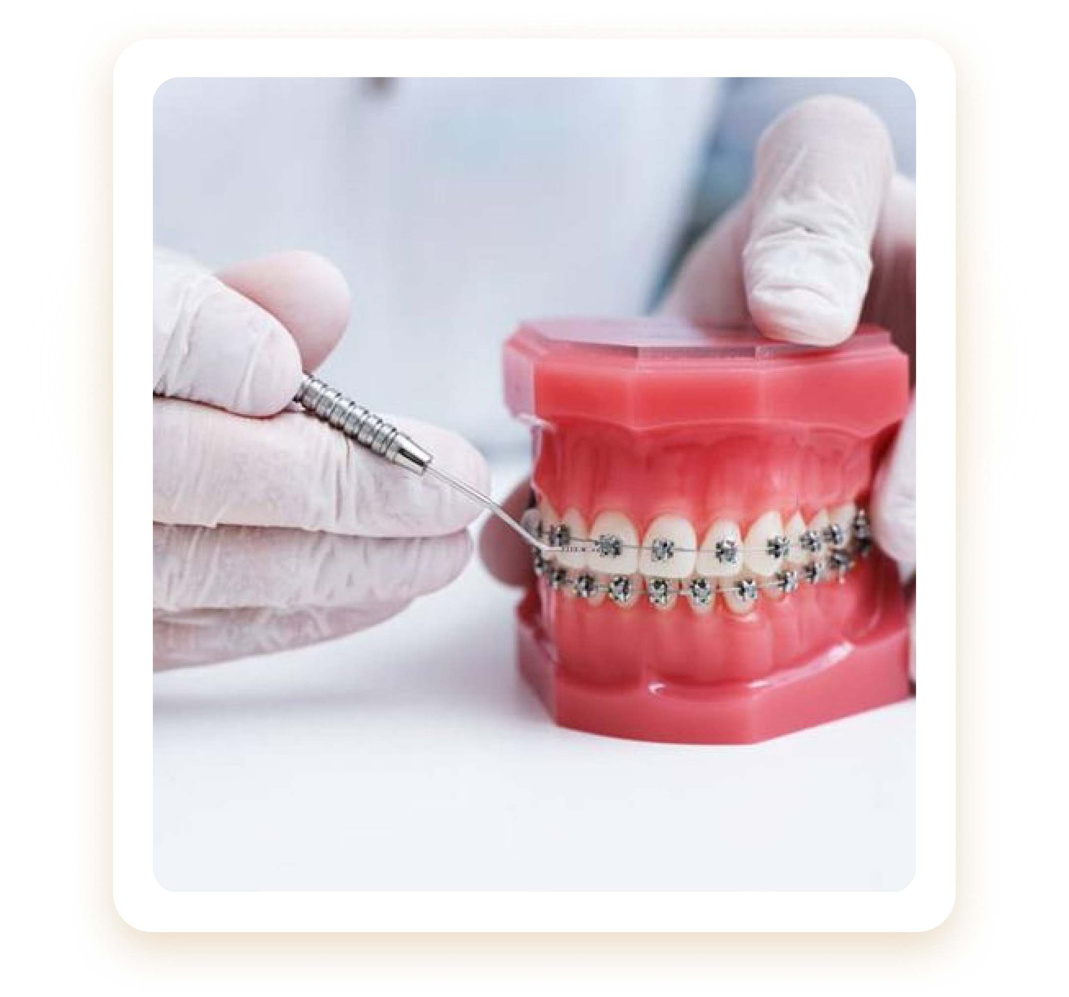 Quy trình niềng răng mắc cài kim loại, điều trị chỉnh nha tại Nha Khoa Phương Thành