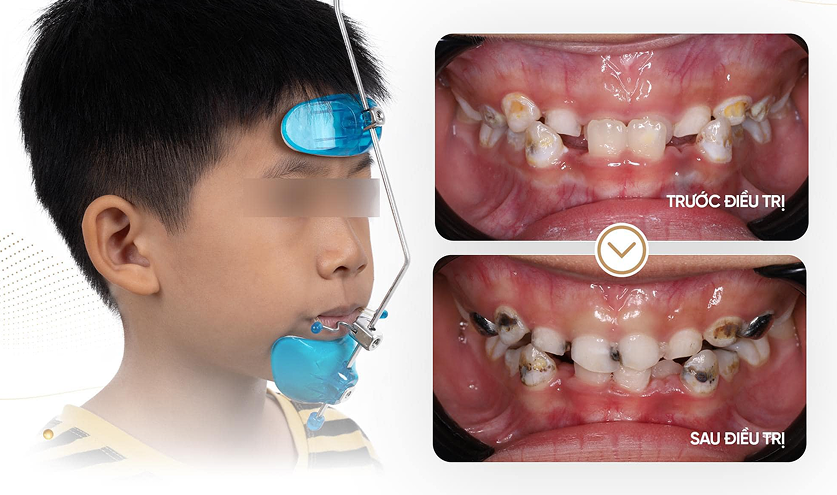 Trẻ em đeo khí cụ chỉnh nha – hiệu quả điều trị răng lệch lạc tại Nha khoa Phương Thành