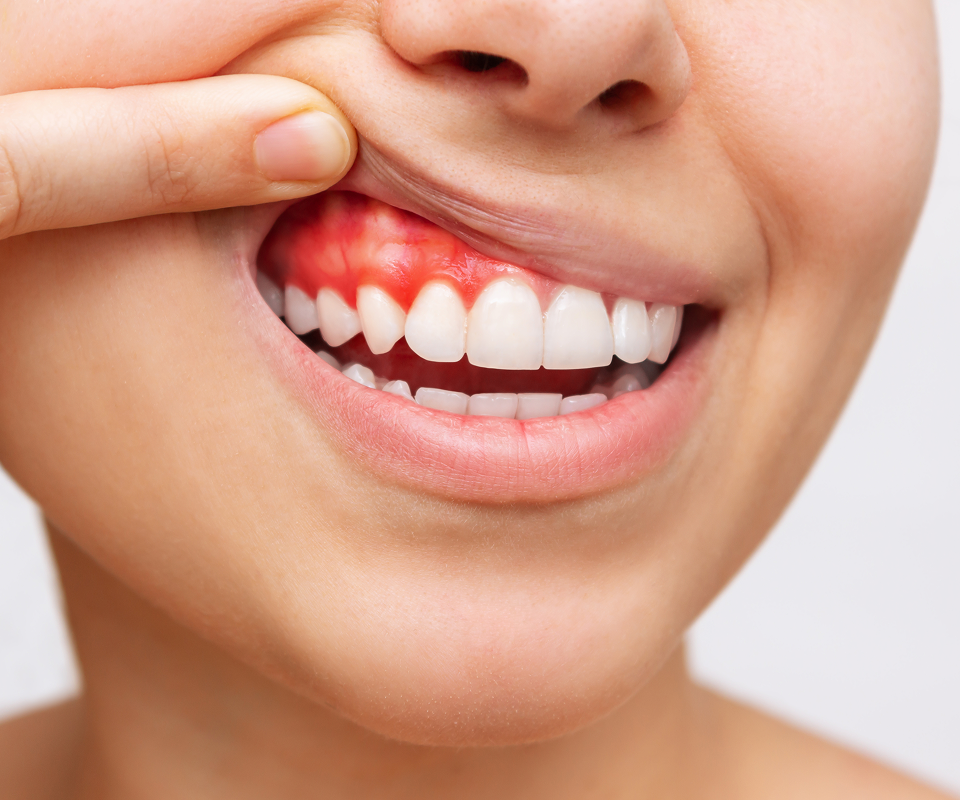 Common Gum-Related Problems: