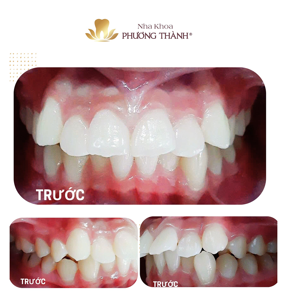 Trước điều trị