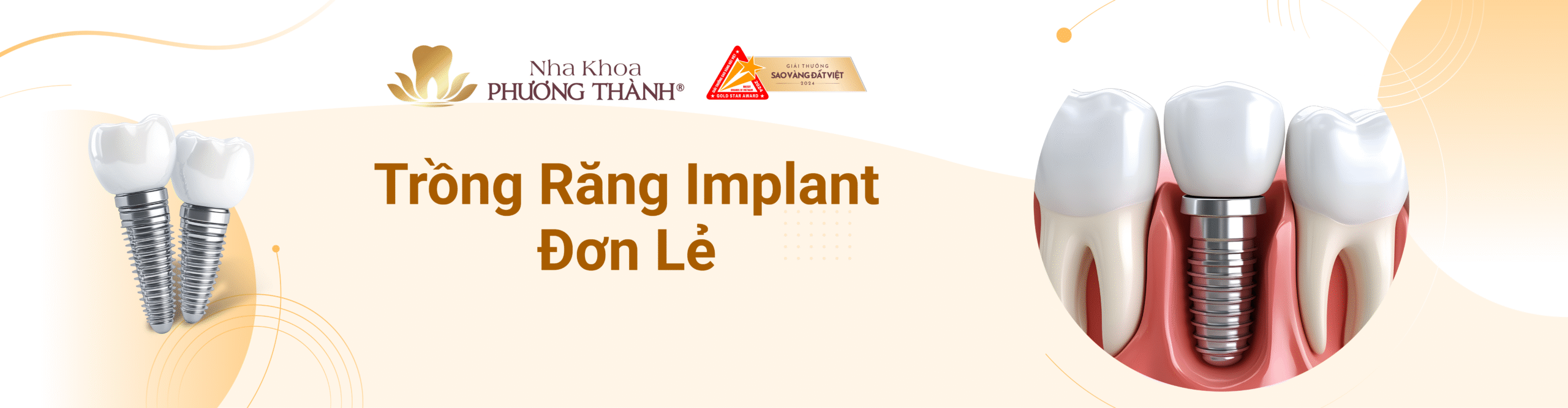 Quảng bá dịch vụ trồng răng implant răng đơn lẻ – phục hình răng mất hiệu quả tại Nha Khoa Phương Thành