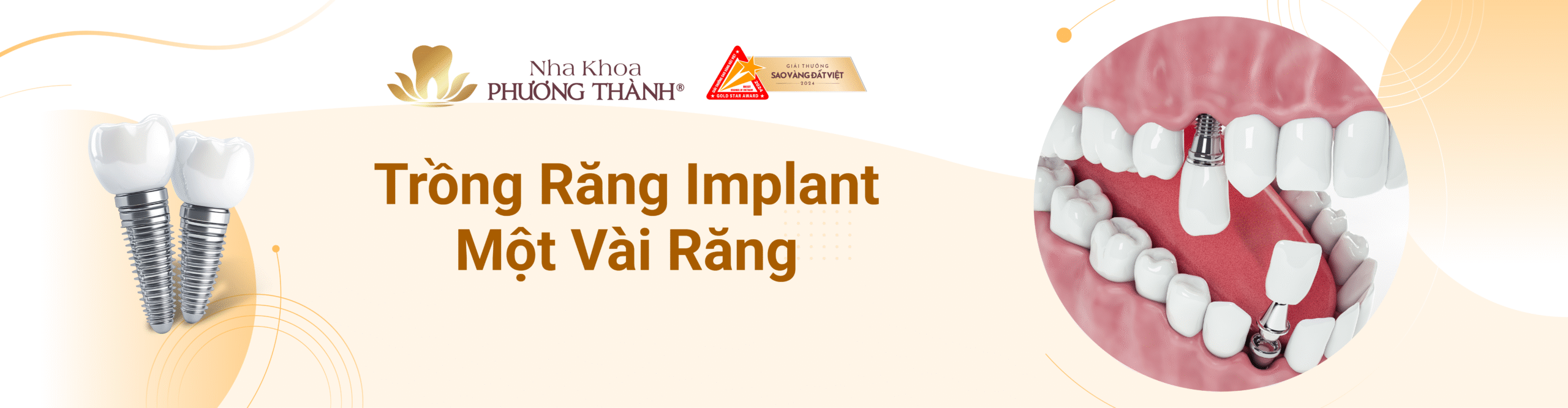 Quảng bá dịch vụ trồng răng implant một vài răng – phục hình răng mất hiệu quả tại Nha Khoa Phương Thành