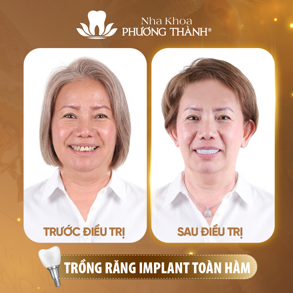 Trồng răng Implant toàn hàm