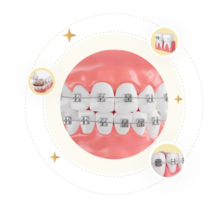 Mô phỏng niềng răng mắc cài kim loại – giải pháp chỉnh nha hiệu quả cải thiện khớp cắn tại Nha Khoa Phương Thành