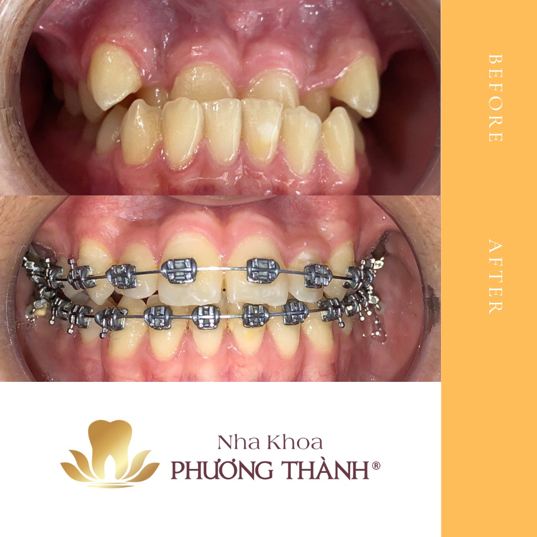 Chỉnh nha răng móm