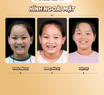 Quá trình niềng răng trẻ em tại nha khoa Phương Thành