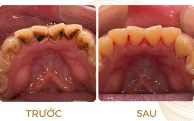 Hình ảnh so sánh trước và sau khi cạo vôi răng