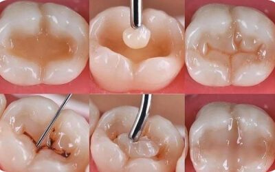 Quy trình trám răng thẩm mỹ từng bước – phục hồi răng sâu tại Nha khoa Phương Thành