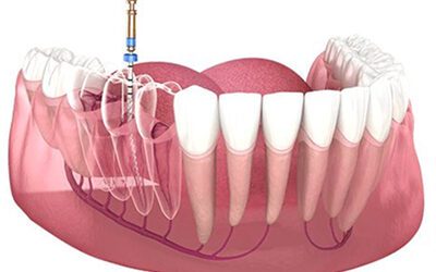 Hình ảnh điều trị tủy răng hàm dưới – quy trình nội nha tại Nha khoa Phương Thành