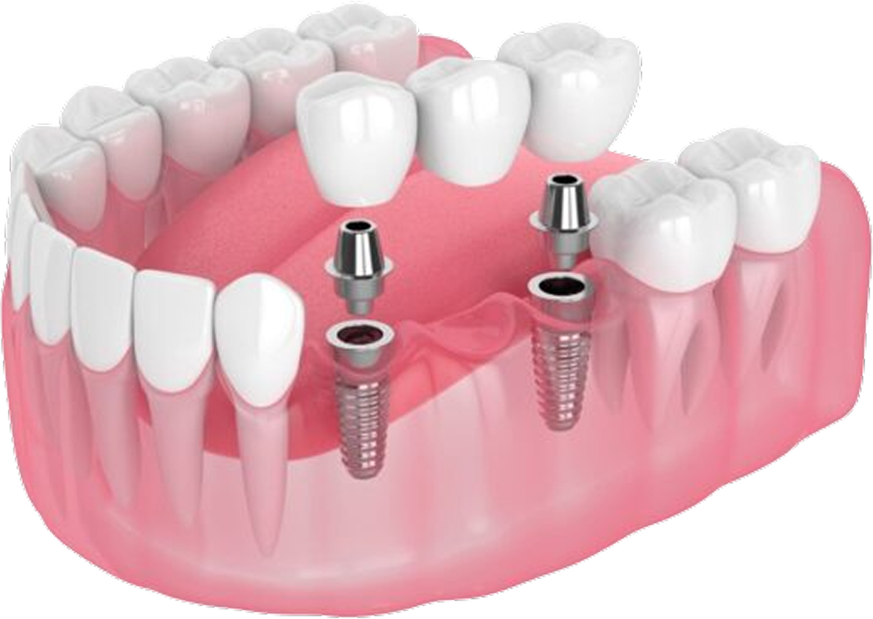 Mô phỏng cấy ghép implant nhiều răng – phục hồi răng mất với trụ titanium, khớp nối và mão sứ tại Nha Khoa Phương Thành