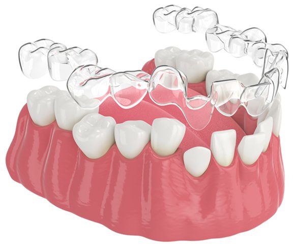 Mô hình khay niềng trong suốt trên hàm răng – giải pháp chỉnh nha thẩm mỹ tại Nha khoa Phương Thành