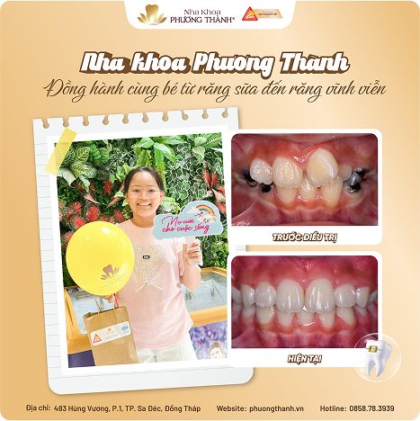 Banner chỉnh nha trẻ em tại Nha Khoa Phương Thành – cải thiện răng lệch lạc, kiến tạo nụ cười độc bản