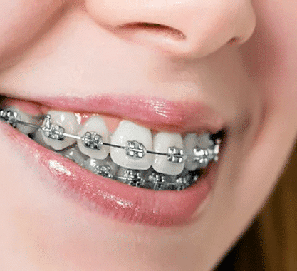 Niềng răng mắc cài tại nha khoa Phương Thành