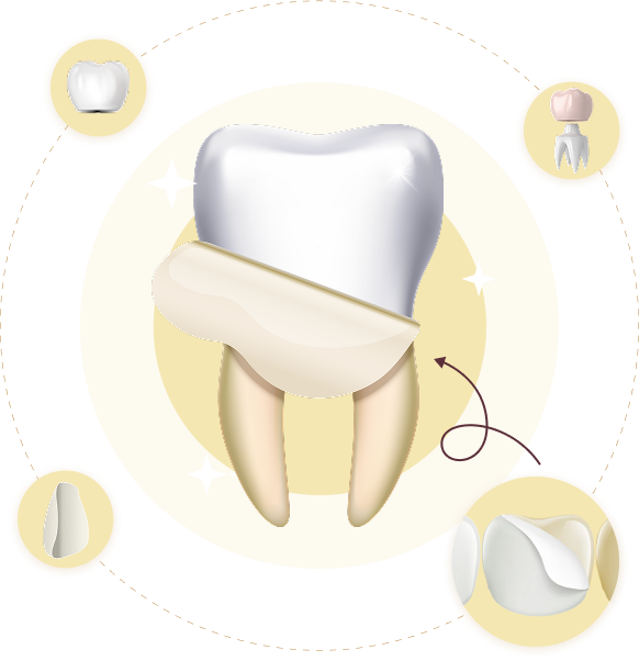 Mô phỏng quy trình bọc răng sứ với các bước minh họa – phục hình thẩm mỹ tại Nha Khoa Phương Thành