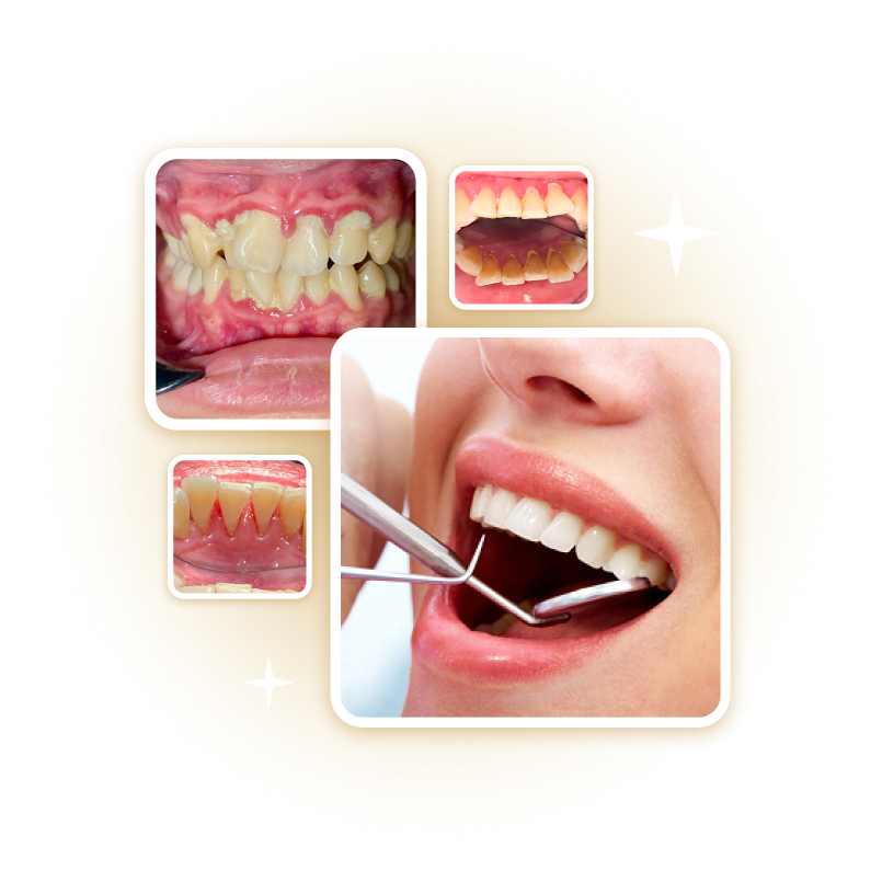 Hình ảnh khách hàng cạo vôi răng, điều trị viêm lợi và nha chu tại Nha khoa Phương Thành