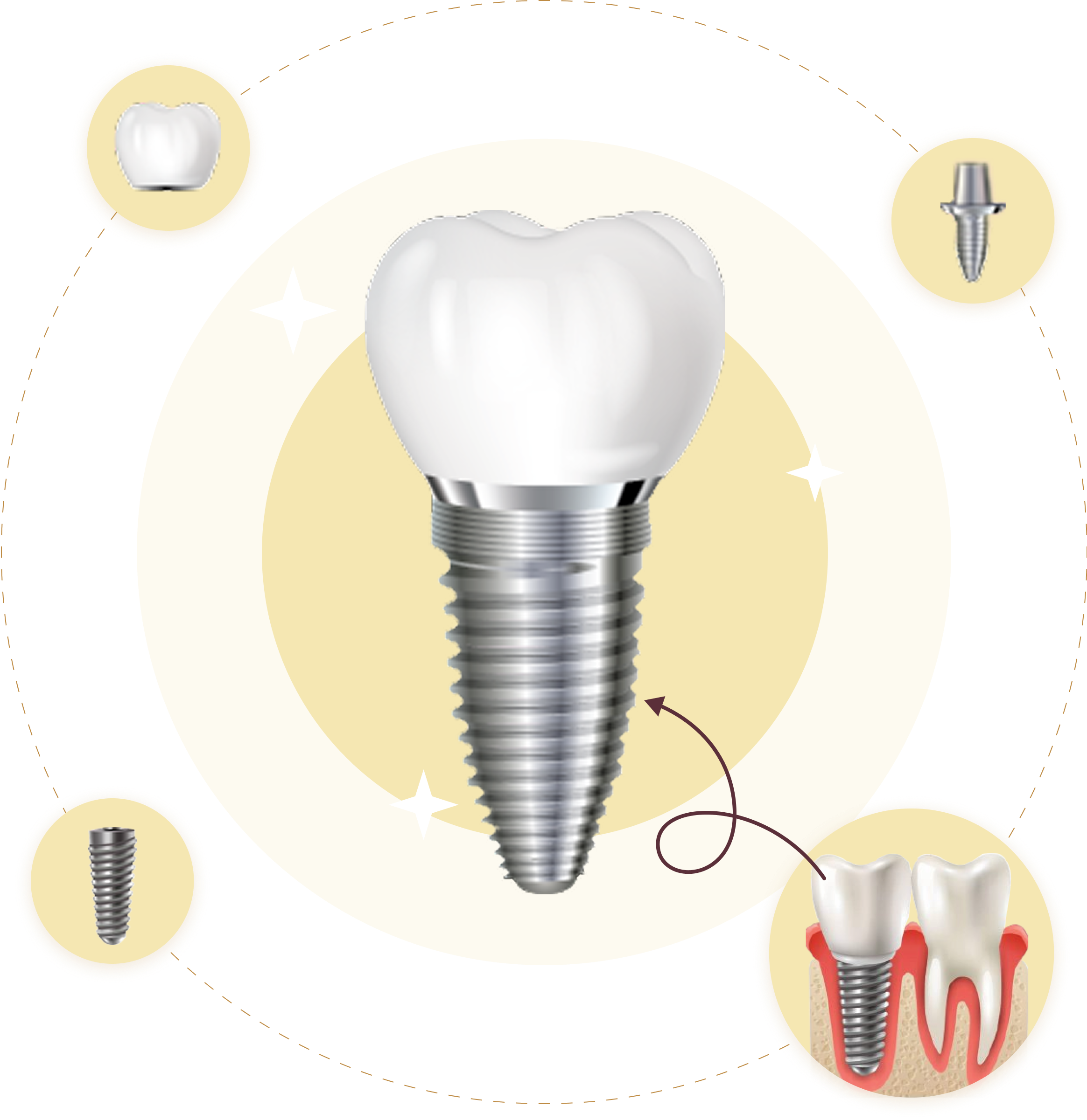 Hình ảnh 3D cấu tạo Implant nha khoa – gồm mão sứ, khớp nối, trụ titan và mô phỏng so sánh với răng thật, minh họa quy trình trồng răng tại Nha Khoa Phương Thành