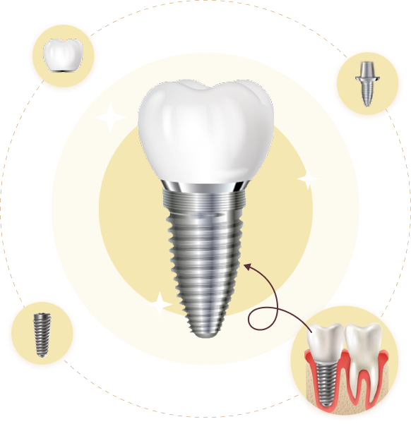 Hình ảnh 3D cấu tạo Implant nha khoa – gồm mão sứ, khớp nối, trụ titan và mô phỏng so sánh với răng thật, minh họa quy trình trồng răng tại Nha Khoa Phương Thành
