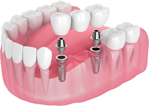 Mô phỏng cấy ghép implant nhiều răng – phục hồi răng mất với trụ titanium, khớp nối và mão sứ tại Nha Khoa Phương Thành