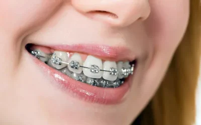 Niềng răng: Tái tạo nụ cười, chuẩn khớp cắn, chuẩn thẩm mỹ