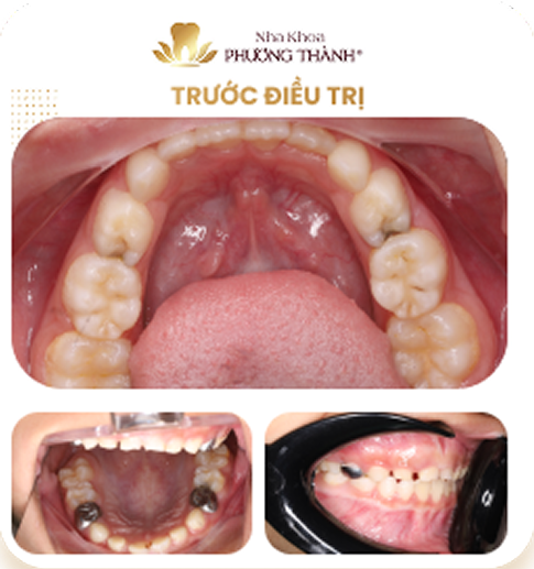 Ảnh so sánh trước và sau điều trị bọc mão thép không gỉ (răng bọc kim loại) cho răng sữa tại Nha khoa Phương Thành
