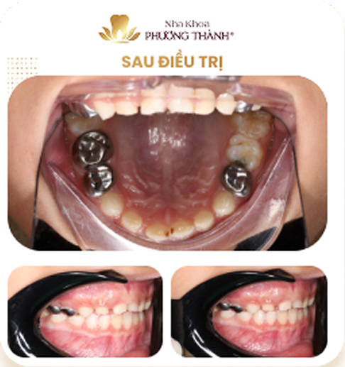 Ảnh so sánh trước và sau điều trị bọc mão thép không gỉ (răng bọc kim loại) cho răng sữa tại Nha khoa Phương Thành
