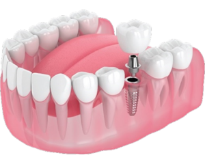 Mô phỏng cấy ghép implant đơn lẻ – phục hồi răng mất với cấu trúc trụ, khớp nối và mão răng