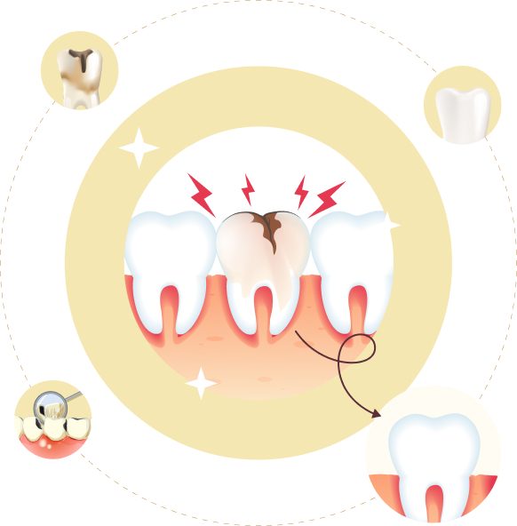Quá trình điều trị sâu răng – từ răng bị tổn thương đến phục hồi tại Nha khoa Phương Thành