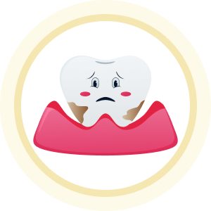 Hình minh họa răng bị mảng bám, vôi răng và nướu bị kích ứng, cần sử dụng dịch vụ cạo vôi răng và vệ sinh nha chu