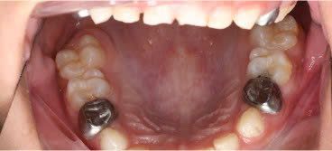 Kết quả phục hình, bọc mão thép không gỉ cho răng sữa của bé tại Nha khoa Phương Thành