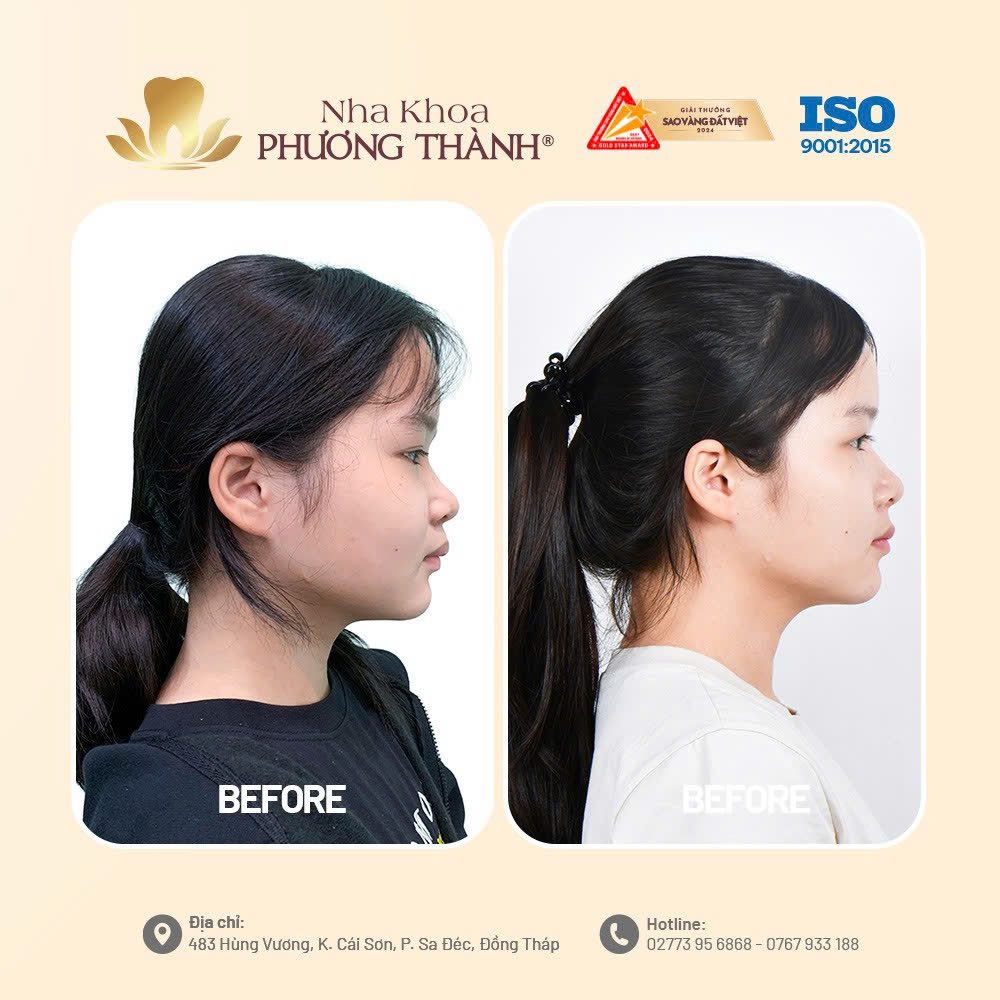 So sánh khuôn mặt trước và sau khi niềng răng tại Nha khoa Phương Thành