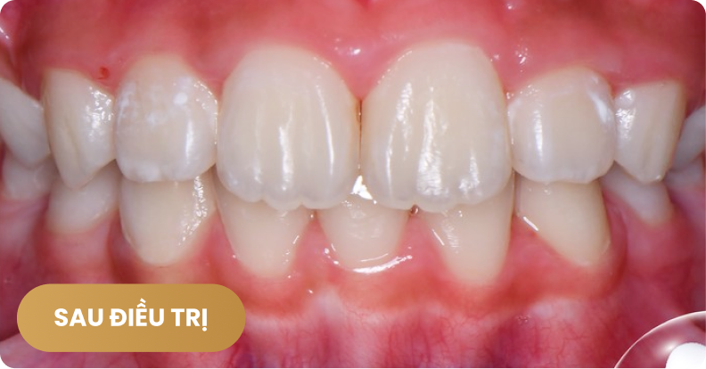 Niềng răng cho trẻ em